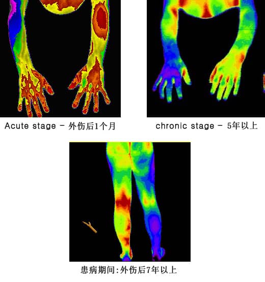 诊断名 : 复杂性区域疼痛综合征 / CRPS  multiple Case