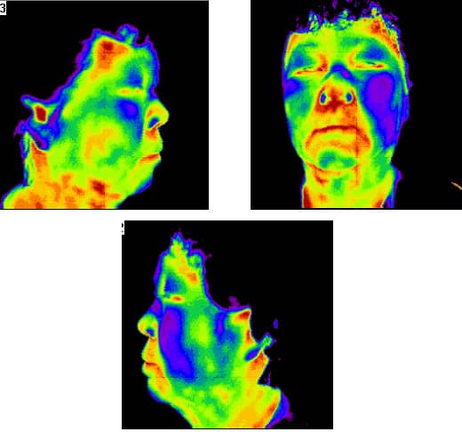 诊断名 : 面瘫 (Facial palsy)