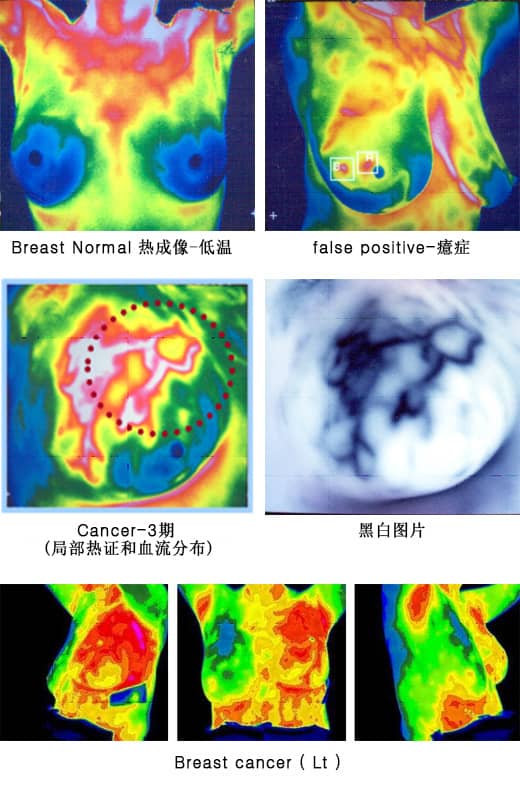 诊断名 : 乳腺癌 (Breast Cancer)